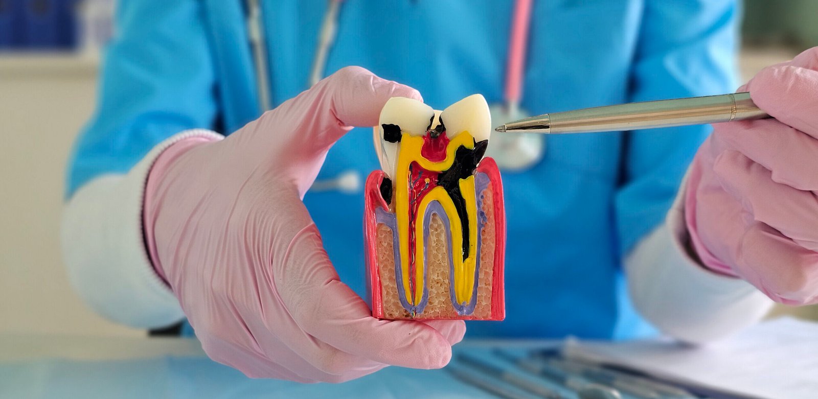 Laser Root Canal in gachibowli