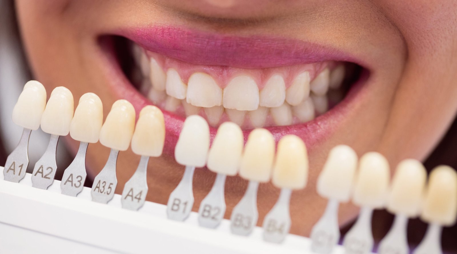 dental veneers in gachibowli