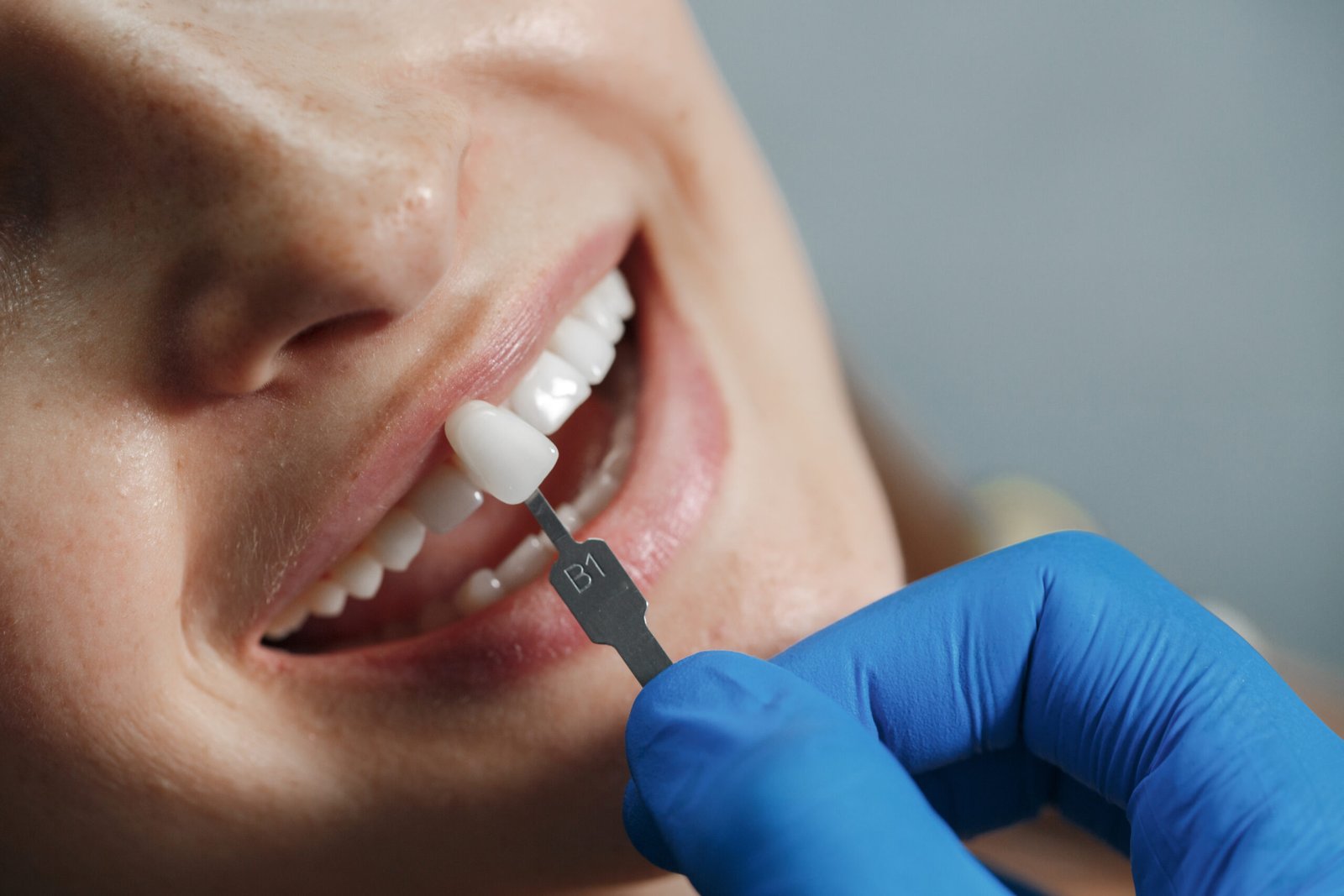 dental veneers treatment
