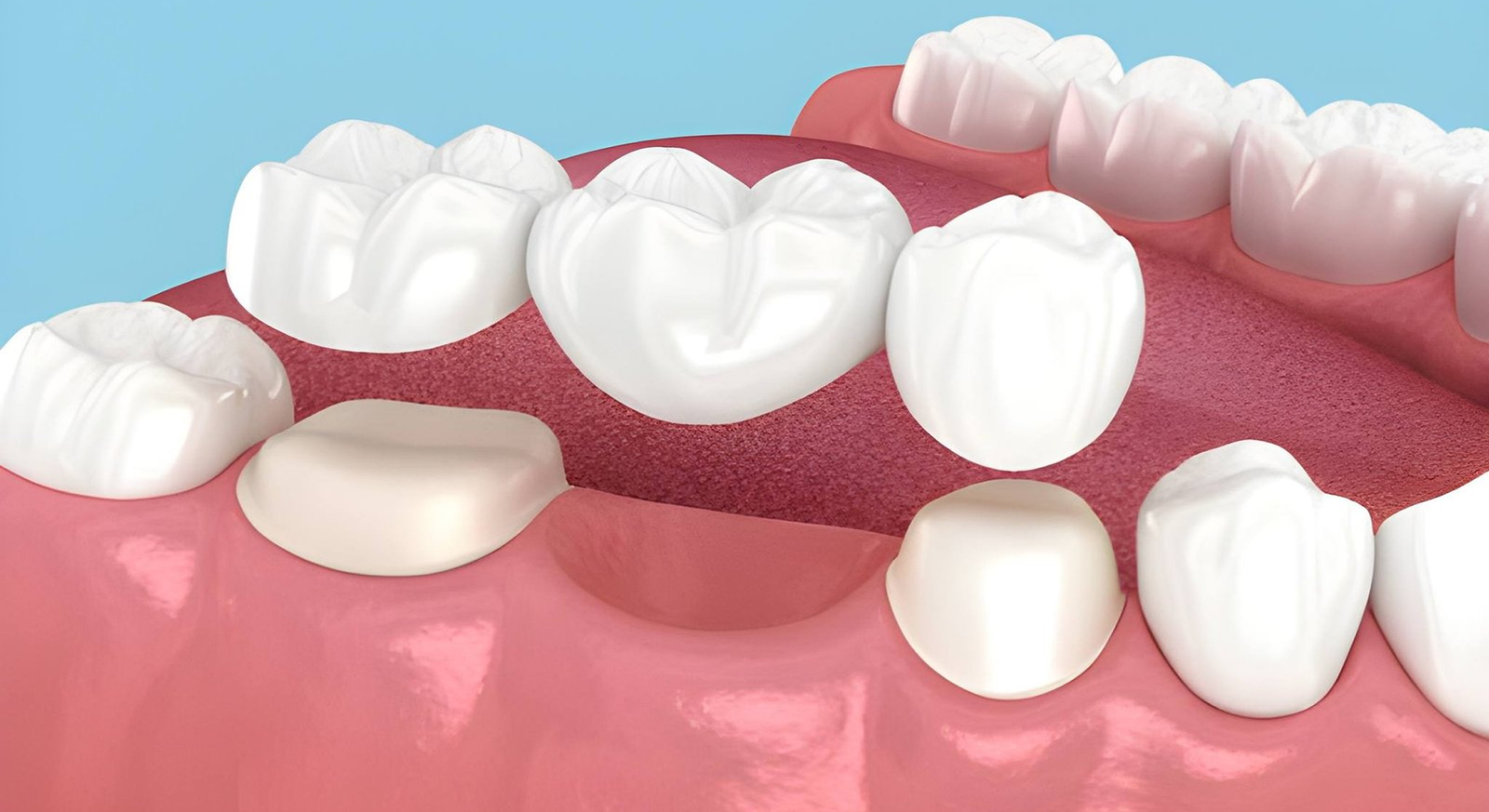 Dental bridges in gachibowli
