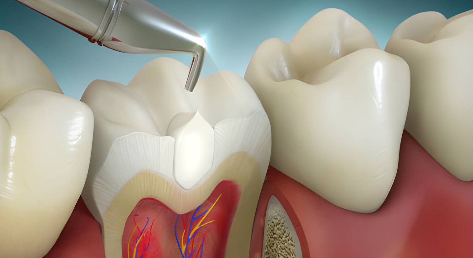 composite fillings in gachibowli