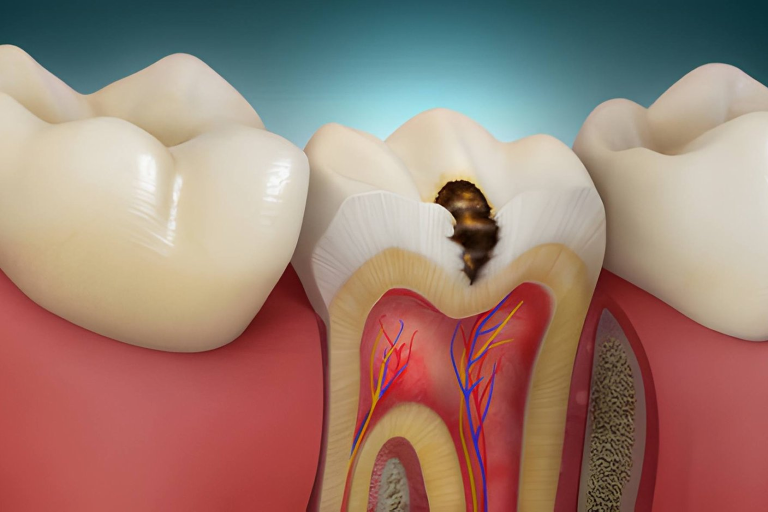 composite filling treatment in chintal