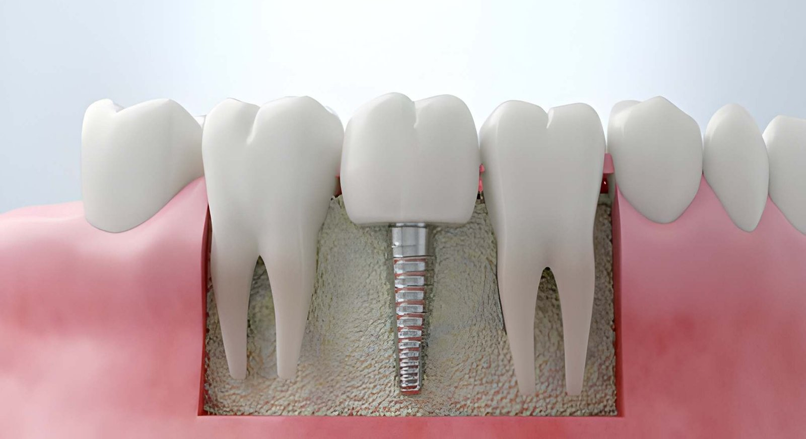 Dental Implants in gachibowli