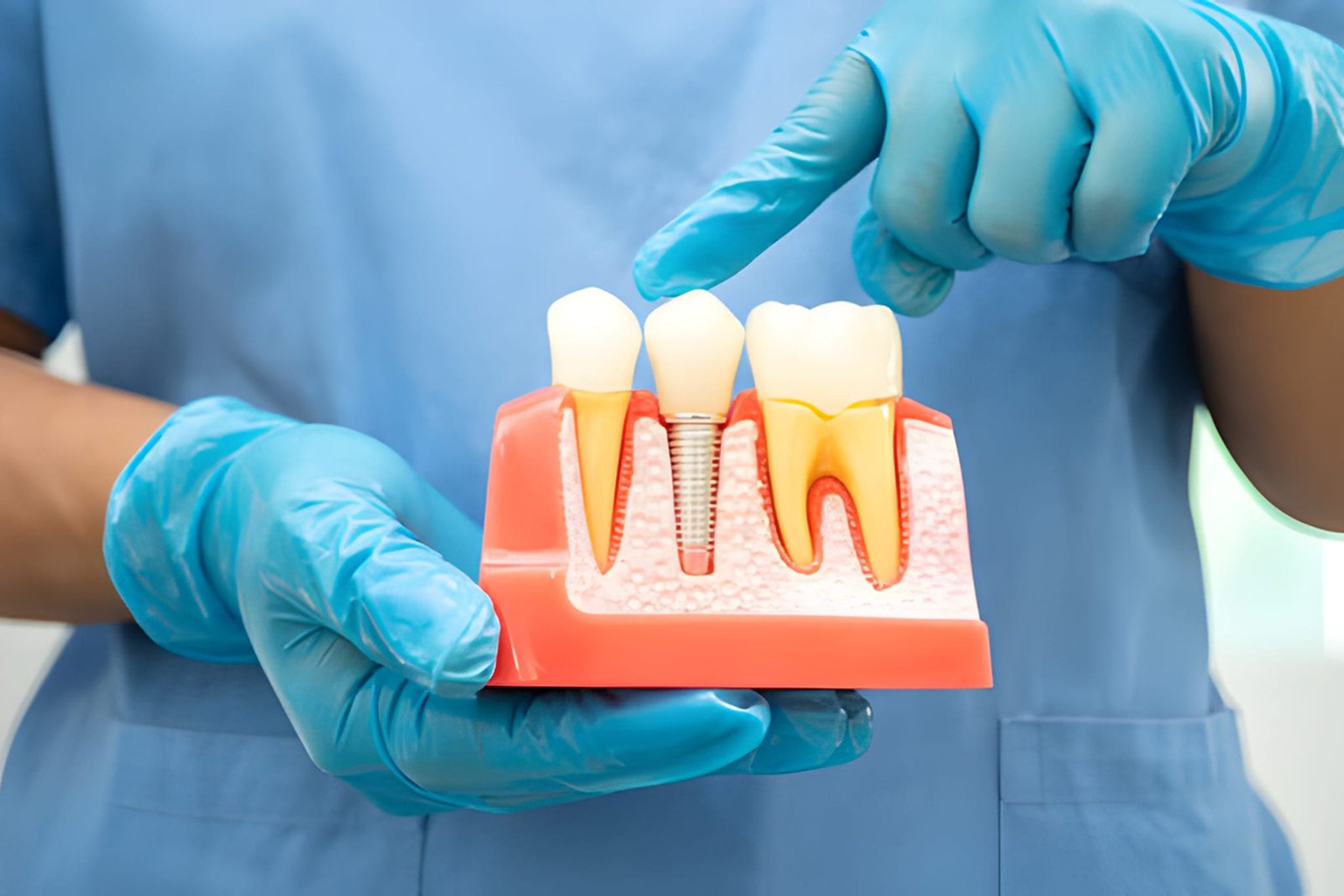 Dental Implants in shapur