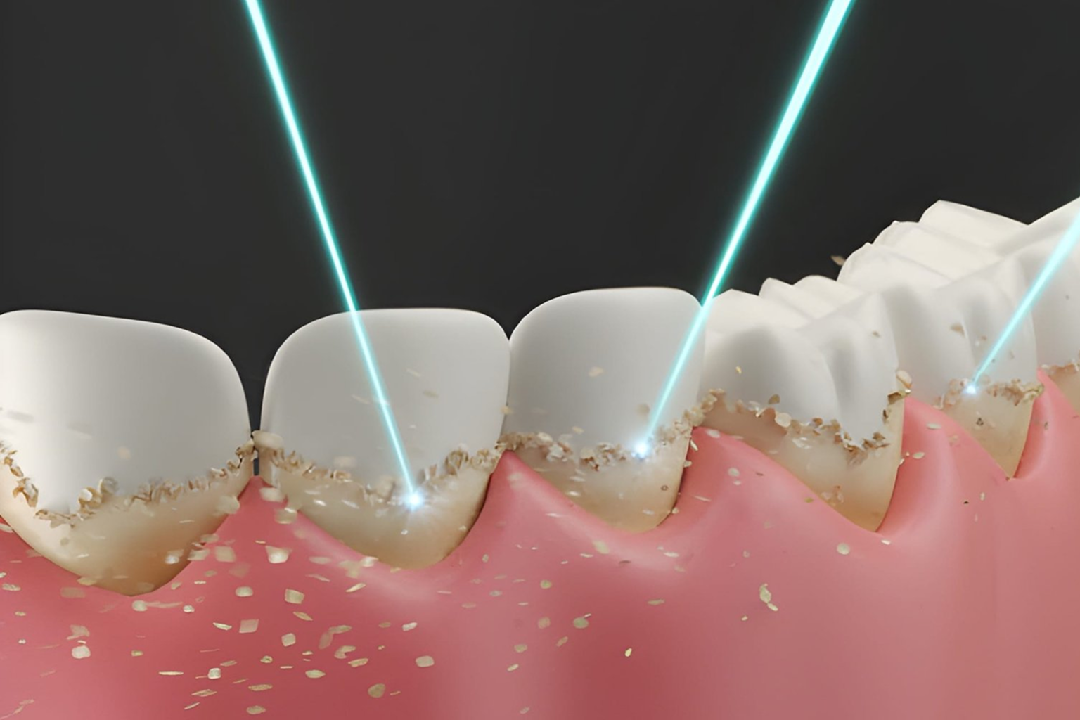Laser Dentistry treatment in Chintal