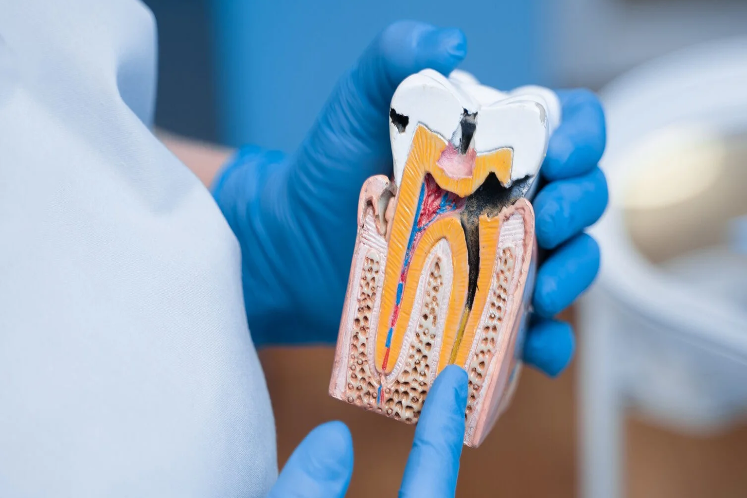 Laser Root Canal treatment in chintal